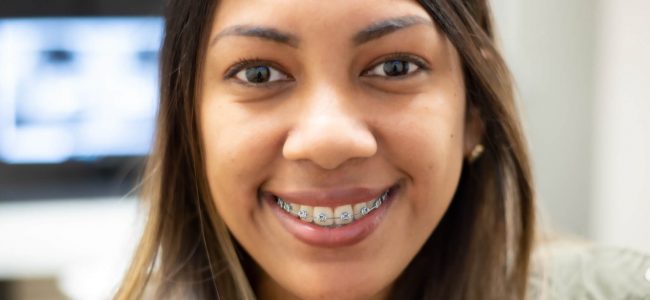 Are Braces Just for Kids? – Options for Adult Braces