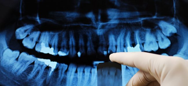Why X-rays Are Important to Your Dental Health