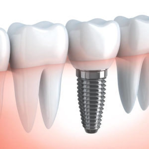 How Long Does the Pain Last After a Dental Implant Portrait