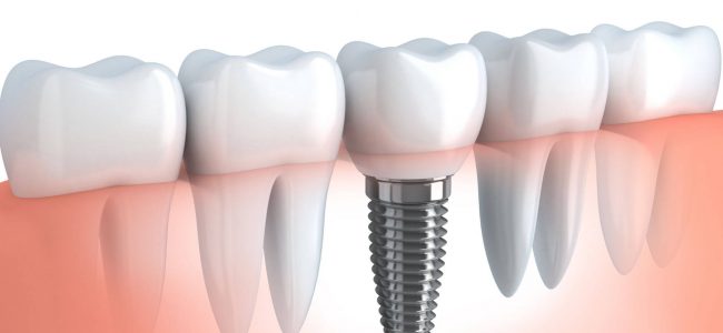 How Long Does the Pain Last After a Dental Implant