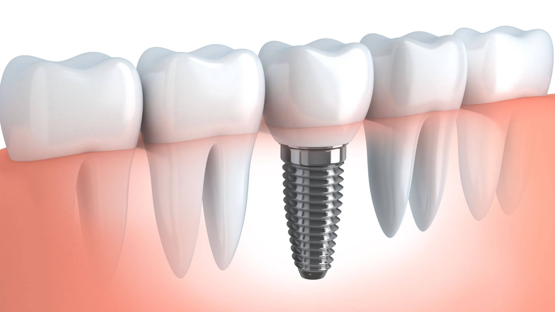 ideal-dental-how-long-does-the-pain-last-after-a-dental-implant